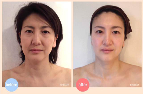 beforeafter