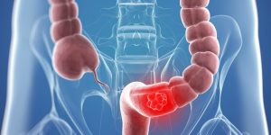 抗大腸癌利器 基因檢測定序對症下藥