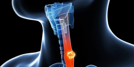 食道癌篩檢　內視鏡「窄頻光譜」一窺究竟！