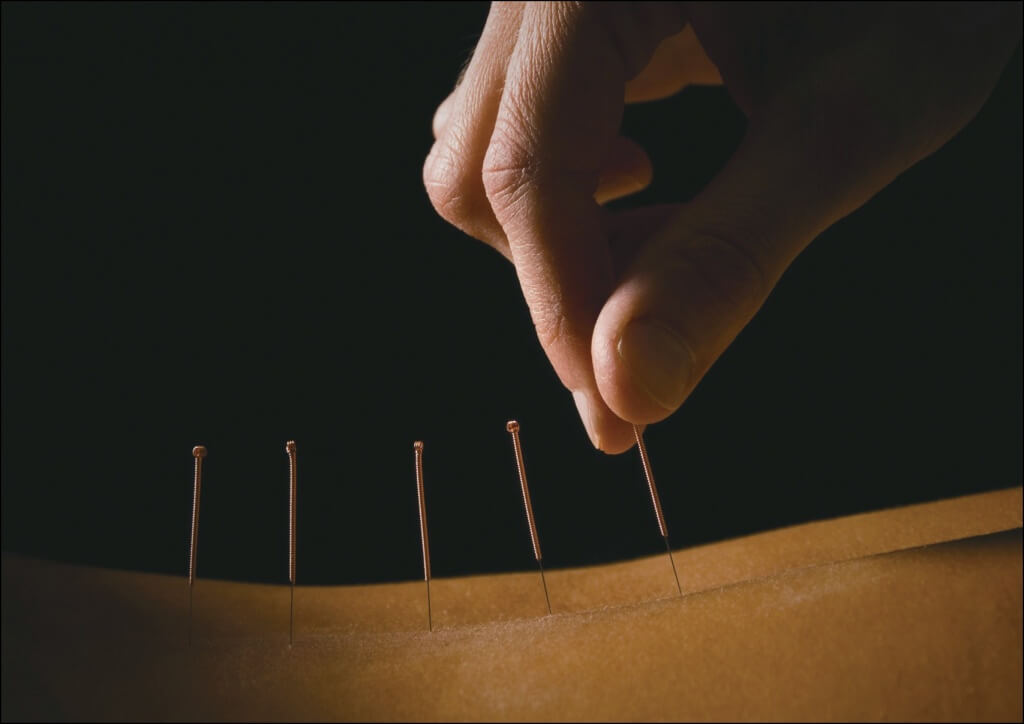 針灸