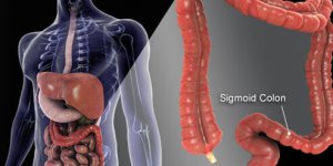 抽血驗大腸癌前病變　準確率高達9成