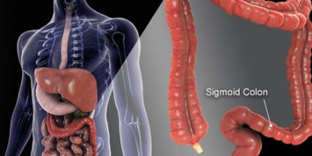 抽血驗大腸癌前病變　準確率高達9成