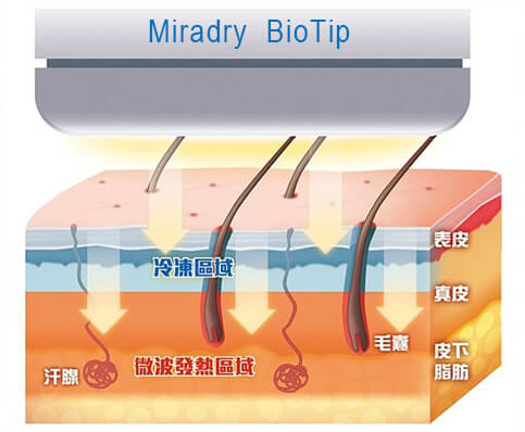 MIRADRY治療原理圖