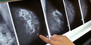 乳癌一二期部份切除效果好　存活率較高