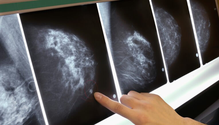 乳癌一二期部份切除效果好　存活率較高