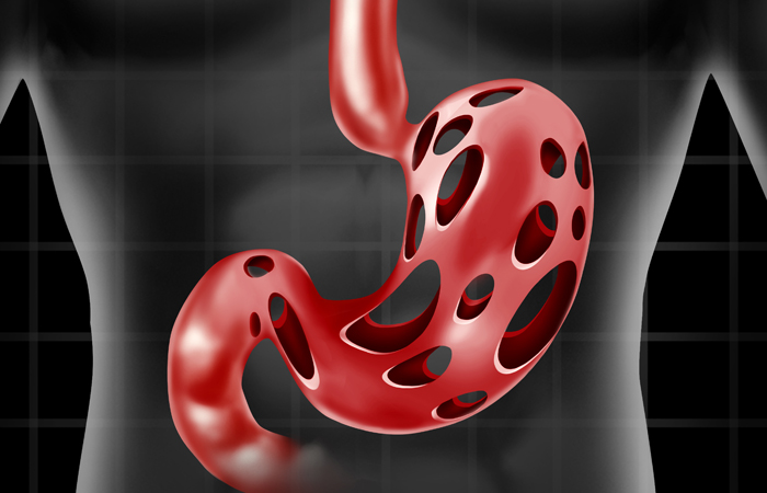 Stomach problem medical health care concept as the human digestion organ with holes as a metaphor for abdominal peptic ulcer pain or gastric acid stress.