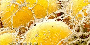 癌細胞轉移 脂肪成關鍵？