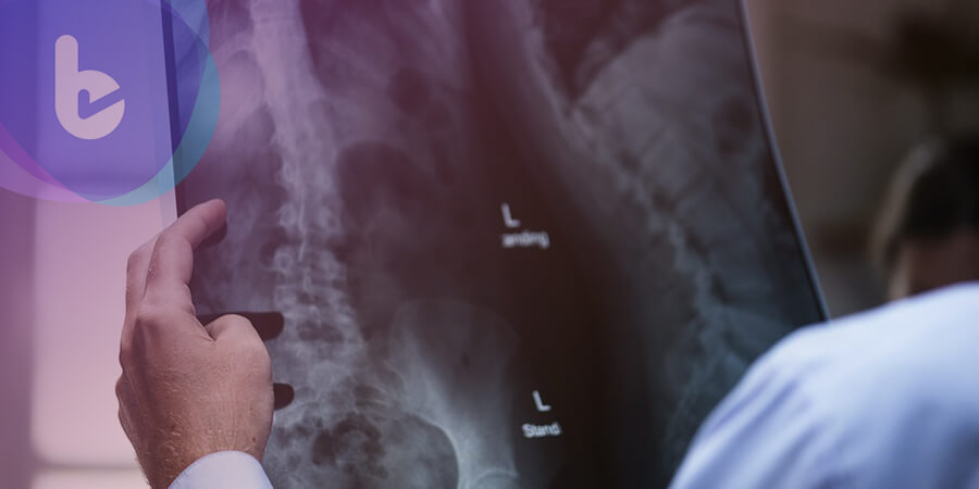 X光驚見骨頭坑坑洞洞　攝護腺癌骨轉移這樣治療可保骨
