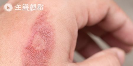 痘疤燒燙疤有救　醫學雷射UP再升級
