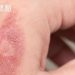 痘疤燒燙疤有救　醫學雷射UP再升級