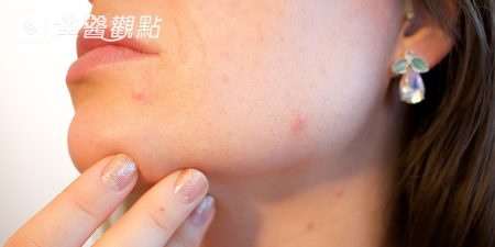 秒懂電波拉皮　醫師呼籲：辨明原廠正貨為安全把關！