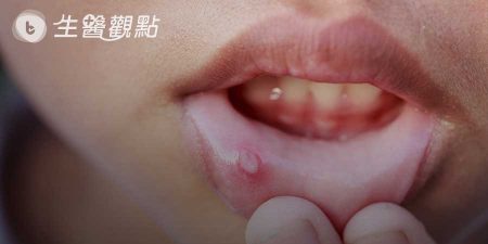 什麼是貝西氏病？臨床表徵及治療保養方式