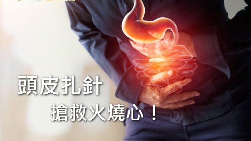 火燒心不見了！「一根針」治好胃食道逆流
