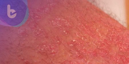 頭皮屑洗不完？臉紅如酒醉　醫師治療、保養乾癬有一套