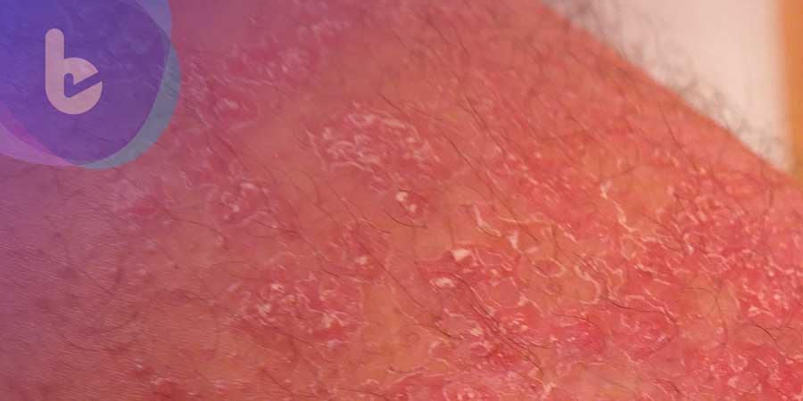 頭皮屑洗不完？臉紅如酒醉　醫師治療、保養乾癬有一套