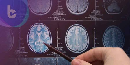 中風後訓練大腦要趁早　肉毒桿菌素舒緩復健手腳
