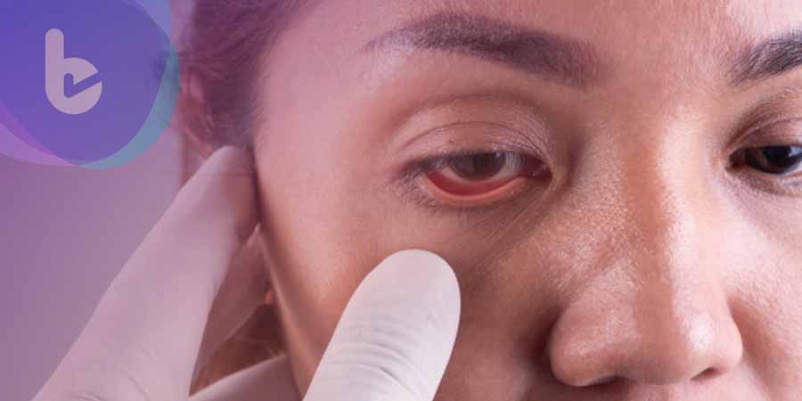 治黃斑水腫反出現嚴重飛蚊症　長效類固醇助回復視界